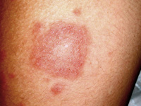 ContactDermatitis