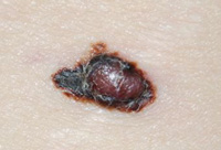 Melanoma1