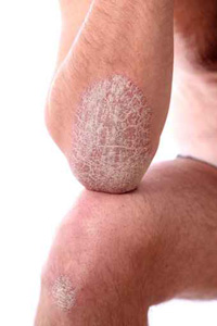 Psoriasis