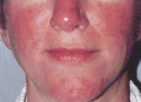 rosacea