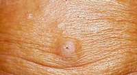 sebaceous cyst